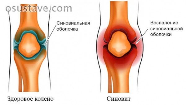 Что такое мениск коленного сустава, возможные повреждения, их причины и лечение