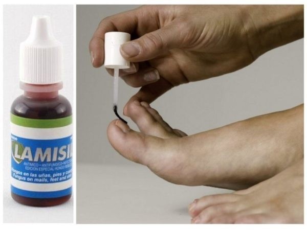 Применение Ламизила для лечения грибка ногтей – инструкция по применению и аналоги препарата