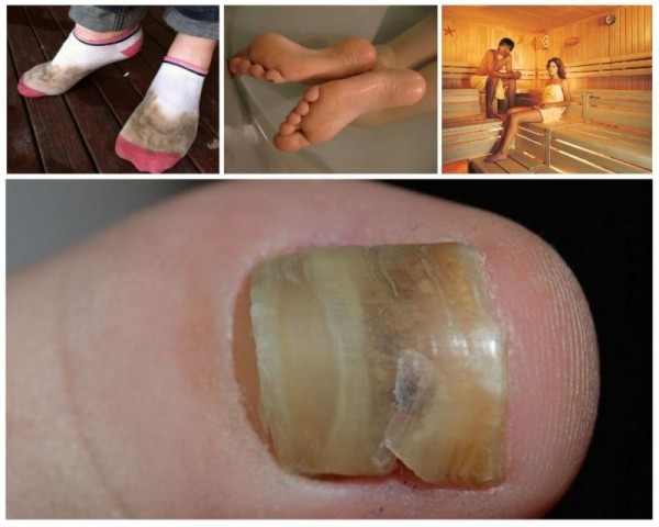 Пути заражения грибковыми заболеваниями ногтей на ногах