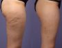 Появление мышечной впадины на ногах ниже или выше колена