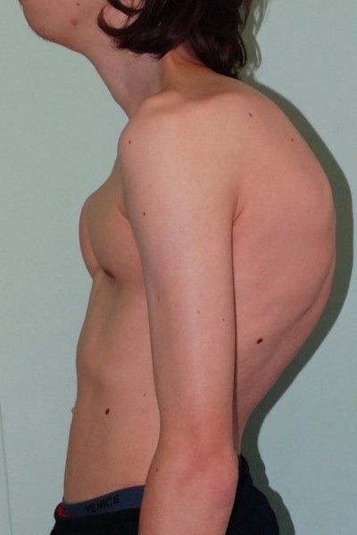 Сглаживание и усиление кифоза грудного отдела позвоночника