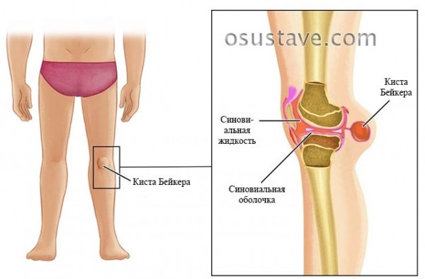 Почему возникает шишка под коленом сзади и спереди, диагностика, лечение