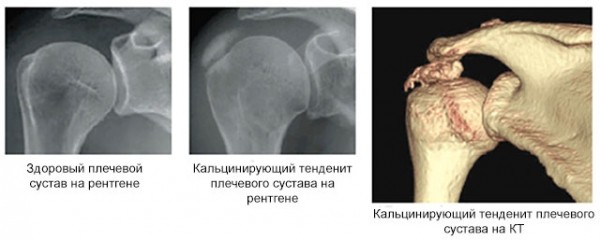 Обзор тендинита плечевого сустава: виды, симптомы и лечение