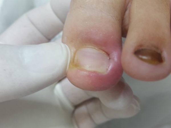 Методы коррекции вросшего ногтя на большом пальце ноги