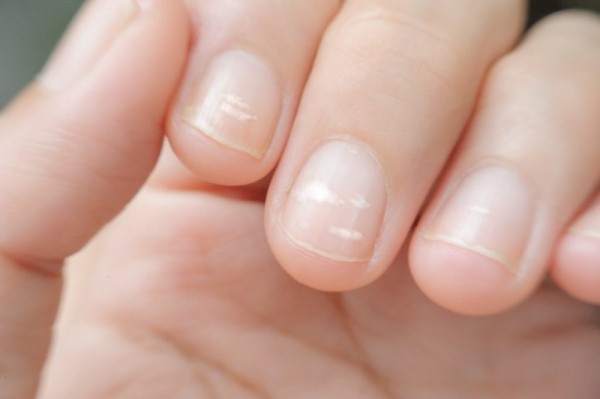 Лейконихия и другие причины появления белых пятен на ногтях