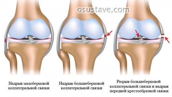 Симптомы и лечение разрыва связок коленного сустава (консервативное, операция)