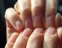 Причины возникновения и методы лечения лейконихии – белых пятен на ногтях