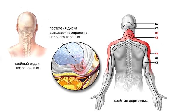 Симптомы и лечение радикулита шейного отдела