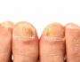 Эффективные способы борьбы с онихомикозом ногтей