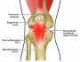 Причины, симптомы, диагностика и лечение тендинита коленного сустава