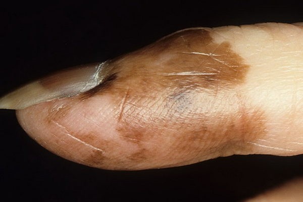 Распознаем рак ногтей на ранней стадии