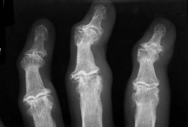 Шишки на суставах пальцев рук: причины, диагностика и лечение
