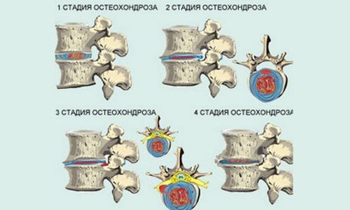 Препараты при остеохондрозе грудного отдела позвоночника