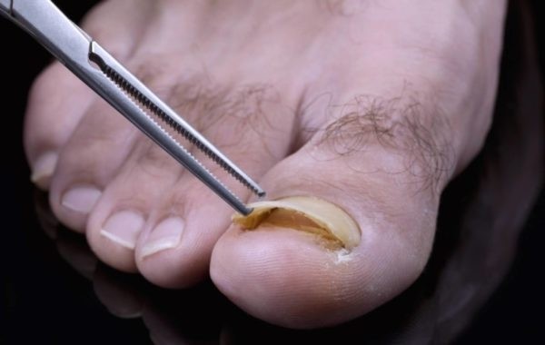 Распознаем грибок ногтей на ногах на начальной стадии