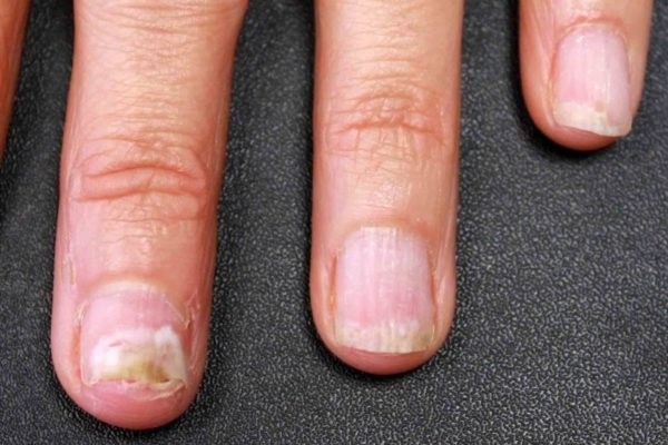 Самые эффективные способы лечения грибка ногтей на руках в домашних условиях