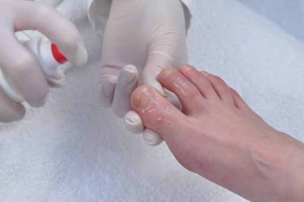 Симптомы и лечение кандидамикоза ногтей