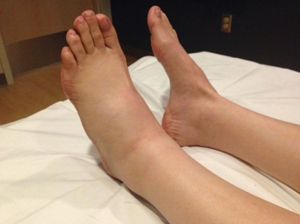 Отек левой ноги (стопы): причины и лечение