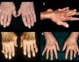 Причины, симптомы и лечение болезней суставов пальцев рук