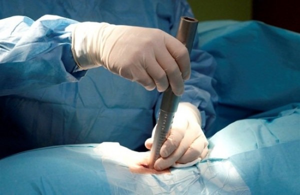 Микрохирургическое удаление грыжи позвоночника (микродискэктомия)