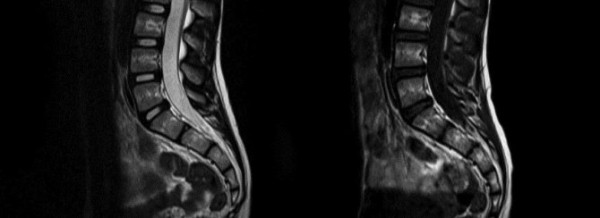 МРТ копчика – что показывает диагностика крестцово-копчикового отдела?