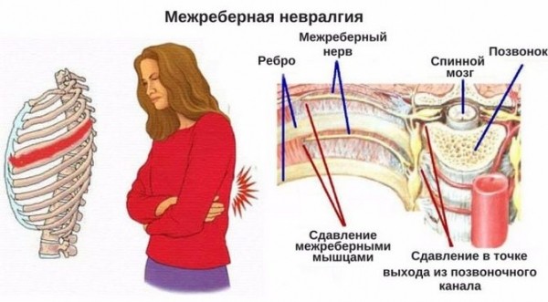 Боль в правом и левом боку при кашле: болит в подреберье