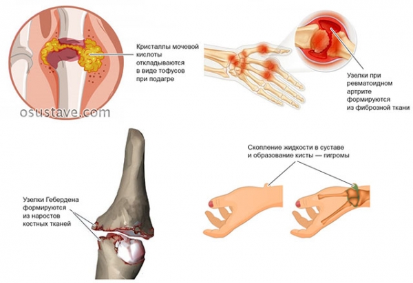 Шишки на суставах пальцев рук: причины, диагностика и лечение