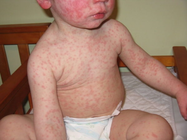 Корь и краснуха – вирусные инфекции с похожими симптомами