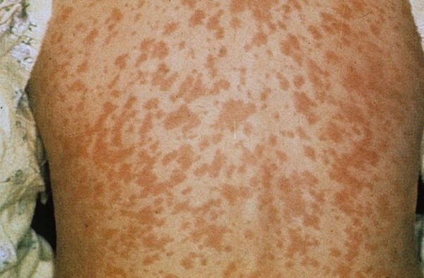 Корь и краснуха – вирусные инфекции с похожими симптомами
