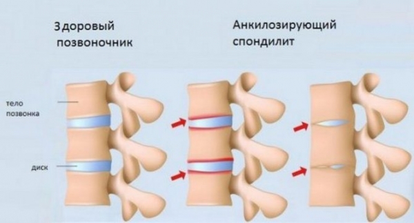 Причины и методы лечения боли в верхней части спины