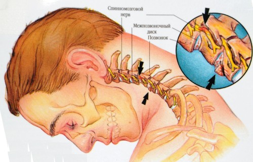 Боль в шее при повороте головы: методы лечения