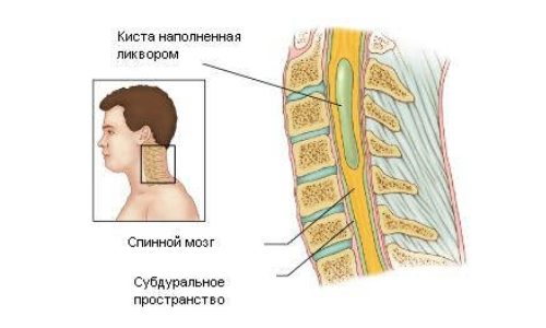 Гидромиелия грудного отдела позвоночника: симптомы и лечение