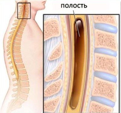 Гидромиелия грудного отдела позвоночника: симптомы и лечение