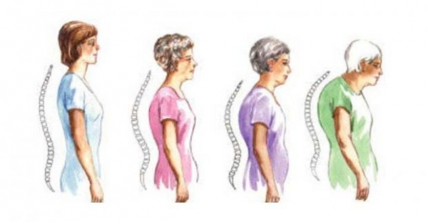 Как делать массаж при кифозе грудного отдела позвоночника