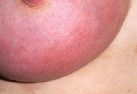 Причины и симптомы покраснений груди при ГВ, лечение и профилактика