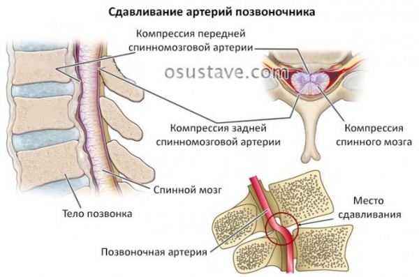 Болит шея и затылок (слева, справа): причины, лечение