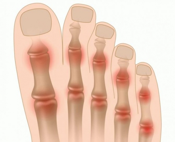 Возникновение онемения большого пальца на ноге